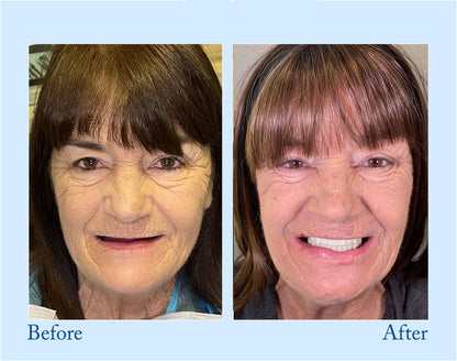 DarkFairy™ - Premium Denture