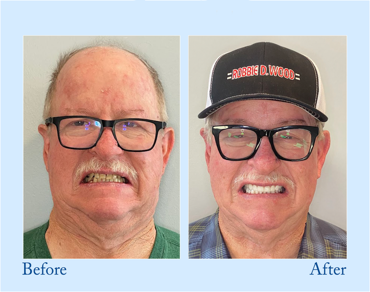 DarkFairy™ - Premium Denture