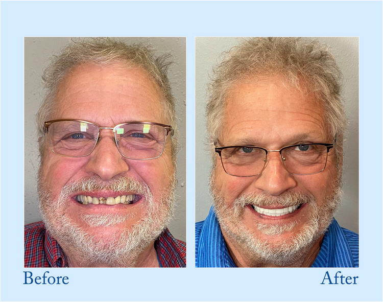 DarkFairy™ - Premium Denture