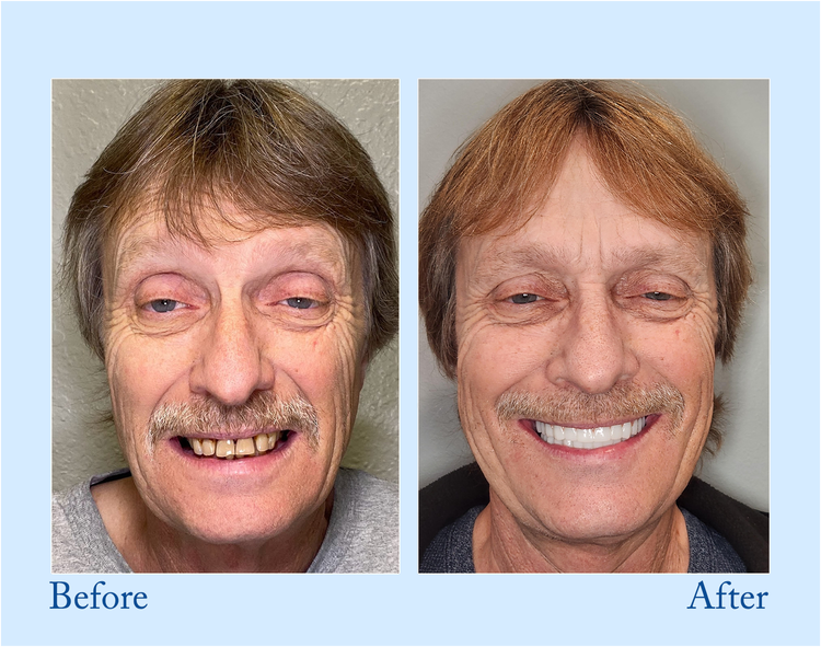 DarkFairy™ - Premium Denture