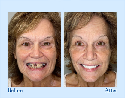DarkFairy™ - Premium Denture